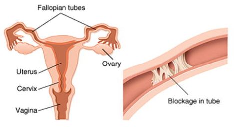 Blocked Fallopian Tubes & Infertility