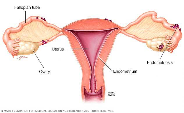 Endometriosis, infertility and hormonal imbalance