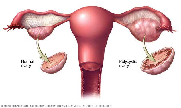 Polycystic Ovarian Syndrome, hormonal imbalance & infertility