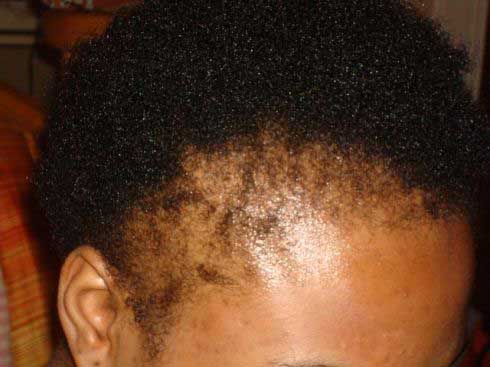 Hair loss due to estrogen dominance